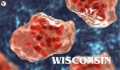 Wisconsin Has Had 171 Measles Cases