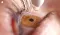 Urgent Eye Drop Recall