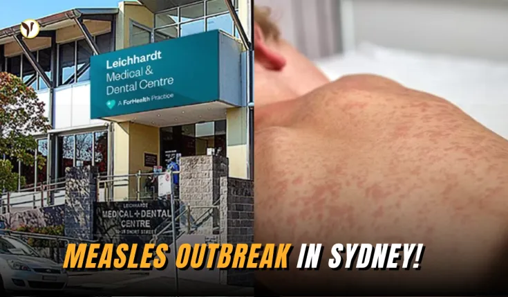 Measles warning in Sydney - Learn how to stay protected